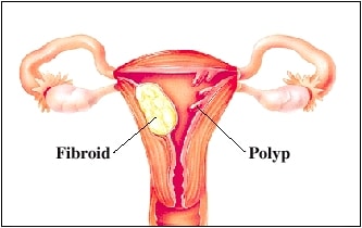 uterine polips