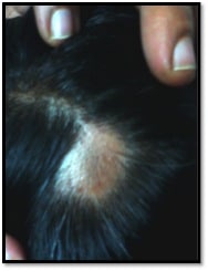 alopecia-areata-before
