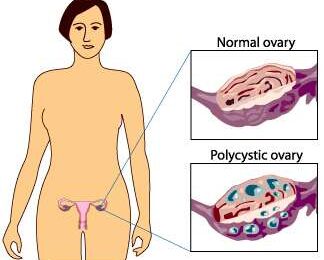 pcod ovary