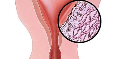 Yeast Infection During Menstruation