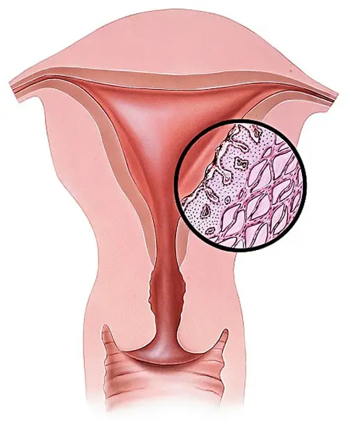 Yeast Infection During Menstruation