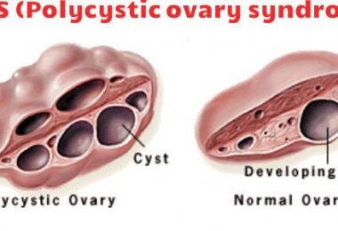 PCOS Polycystic ovary syndrome