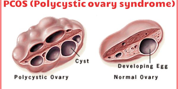 PCOS Polycystic ovary syndrome