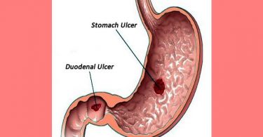 stomach ulcer and duodenal ulcer