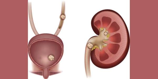 causes of kidney stones, symptoms and treatment of kidney stones