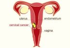 Cervical Cancer During Pregnancy