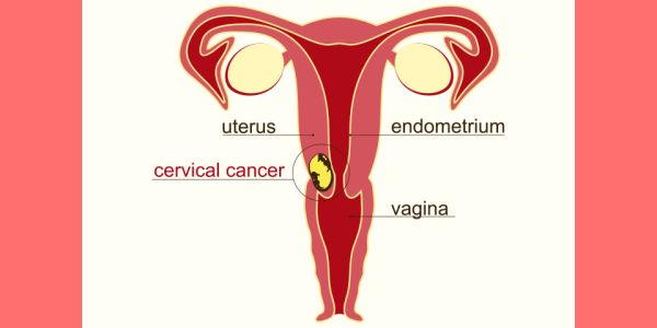 Cervical Cancer During Pregnancy