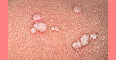 Genital Warts vs Skin Tags