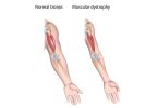 dystrophic arm muscle