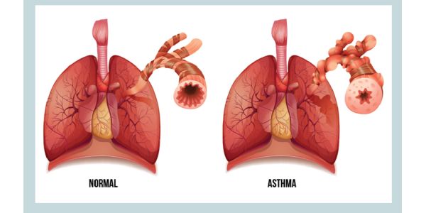 asthma homeopathy treatment