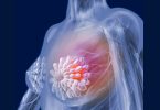 breast cancer cause symptoms treatment