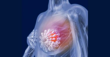 breast cancer cause symptoms treatment
