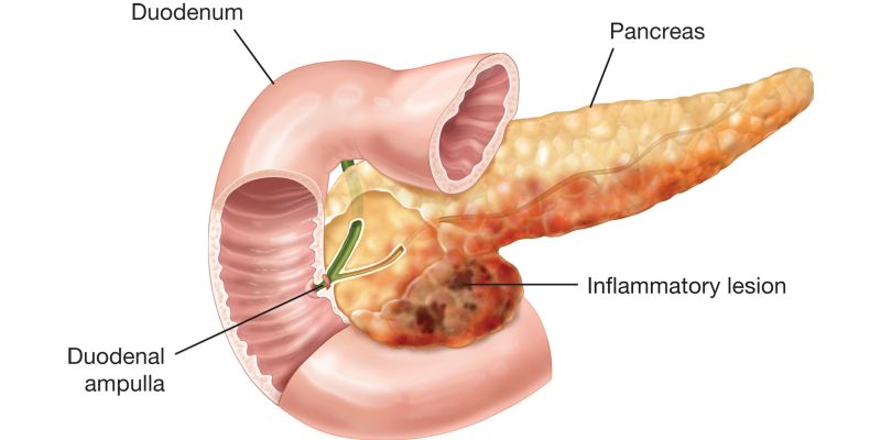 Pancreatitis inflammation