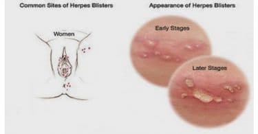 herpes pictures