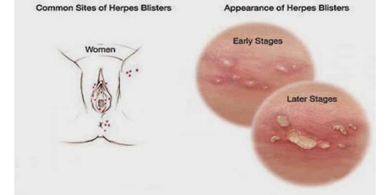 herpes pictures