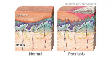 nucleus rm photo of illustration of psoriasis