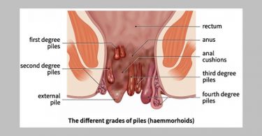 haemorrhoid grades