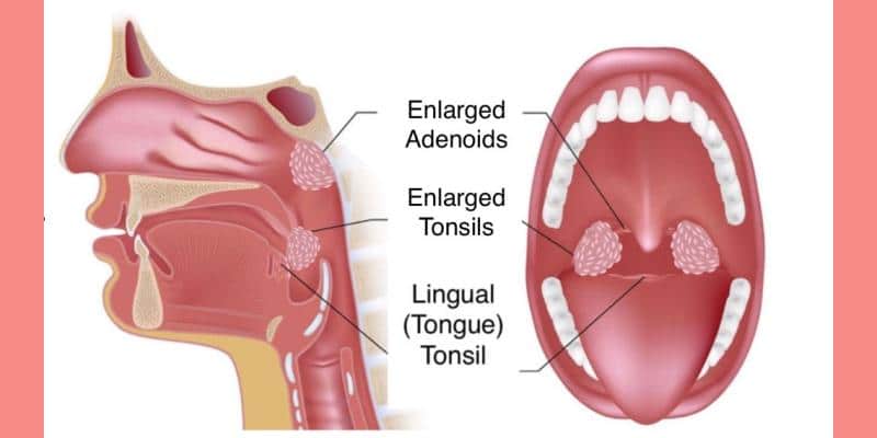 Enlarged Tonsils and Adenoids