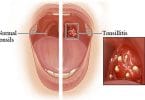 tonsilitis