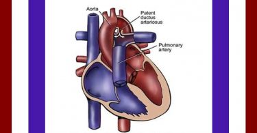 pediatric patent ductus arteriosus