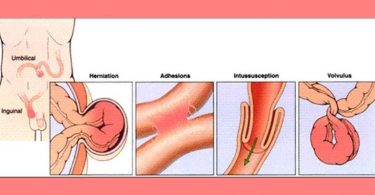 intestinal obstruction types