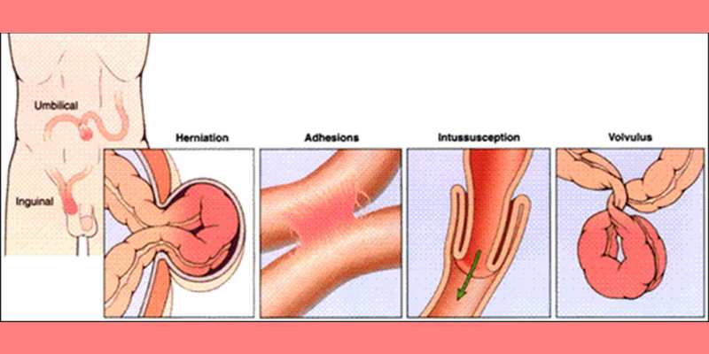 intestinal obstruction types
