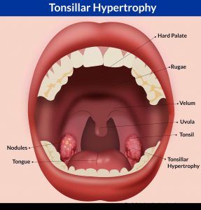 tonsillitis homeopathy treatment 