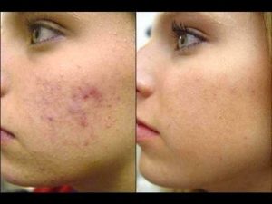 homeopathic medciine for acne treatment