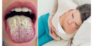 homeopathic medicine for candidiasis