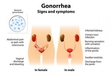 gonorrhea