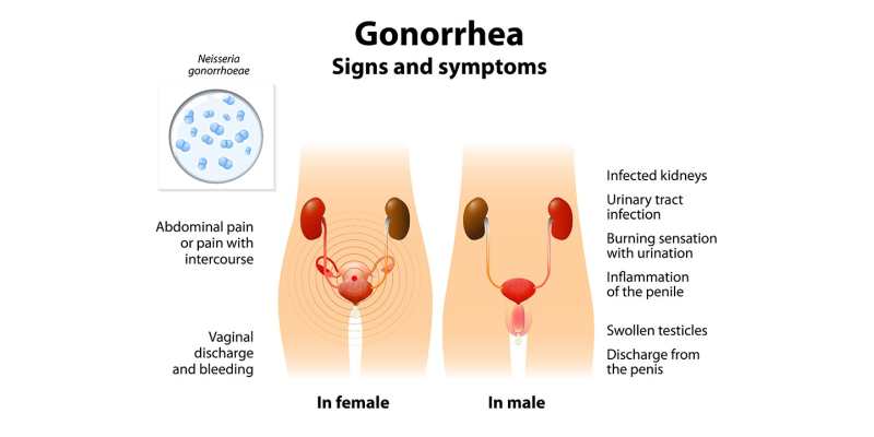 gonorrhea