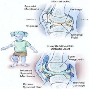 juvenile arthritis rheumatoid arthritis