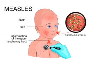 meales symptoms. homeopathic cure for measles.