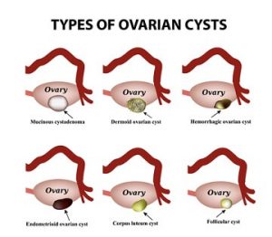 homeopathic medicine for ovarian cyst