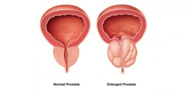 prostate bph