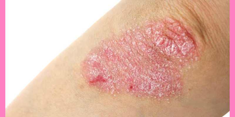Chronic Eczema in a Woman of 66