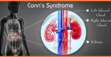 Conn’s Syndrome (Primary Hyperaldosteronism)  A Homeopathic Approach