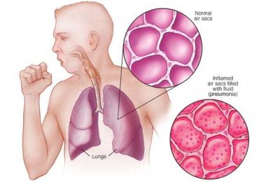 Homoeopathic Management of Pneumonia