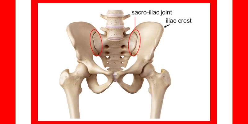 Sclerosis of Unilateral Sacroiliac Joint in a Woman of 27
