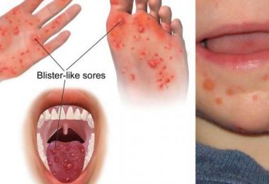 A Case of Hand, Foot and Mouth Disease