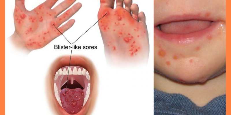 A Case of Hand, Foot and Mouth Disease