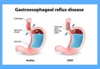 A Case of Gastroesophageal and Duodenogastric Reflux with the Background of Chronic Duodenitis Associated with Helicobacter Pylori