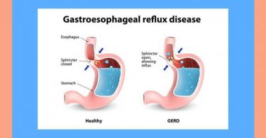 A Case of Gastroesophageal and Duodenogastric Reflux with the Background of Chronic Duodenitis Associated with Helicobacter Pylori