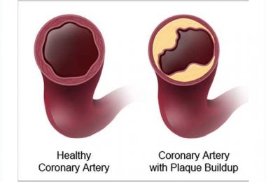 A Case Diagnosed as Coronary Artery Stenosis
