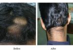 Alopecia Areata in a Man of 17