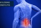 Ankylosing Spondylitis – An Introduction and Keynotes of Often Indicated Remedies