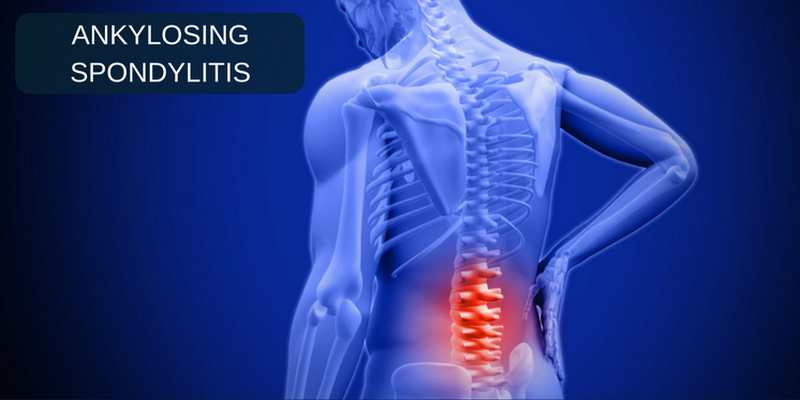 Ankylosing Spondylitis – An Introduction and Keynotes of Often Indicated Remedies