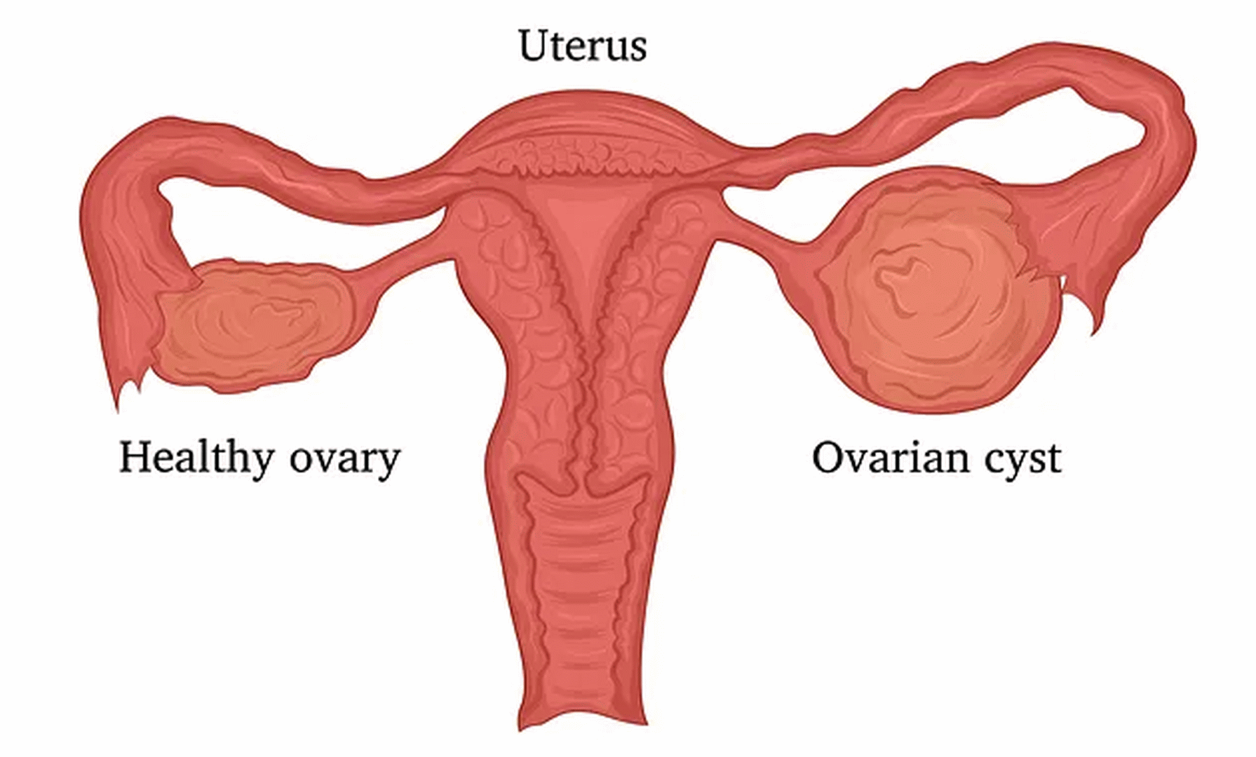Dermoid Cyst of Left Ovary – Woman of 28 - Piyu Amit Chandani